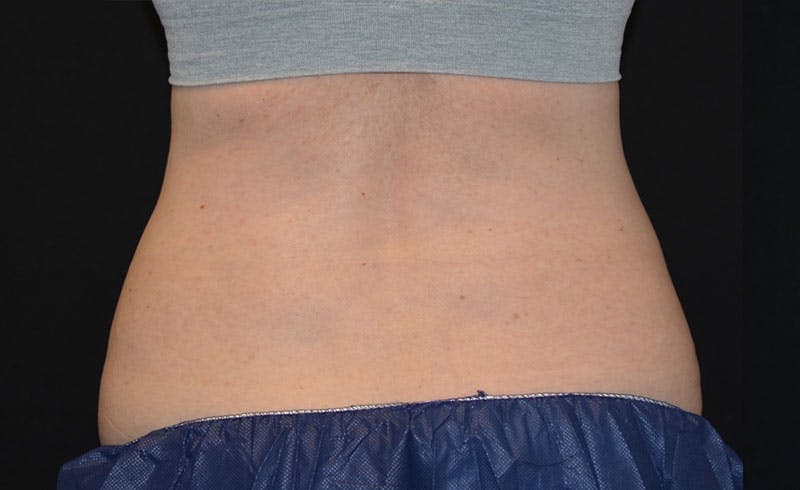 Female Love Handles Before & After Gallery - Patient 761247 - Image 1