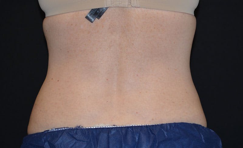 Female Love Handles Before & After Gallery - Patient 761247 - Image 2
