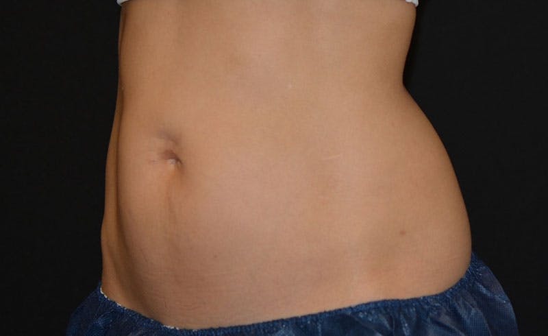 Female Love Handles Before & After Gallery - Patient 354260 - Image 1