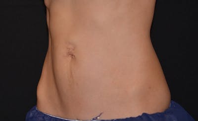 Female Love Handles Before & After Gallery - Patient 354260 - Image 2