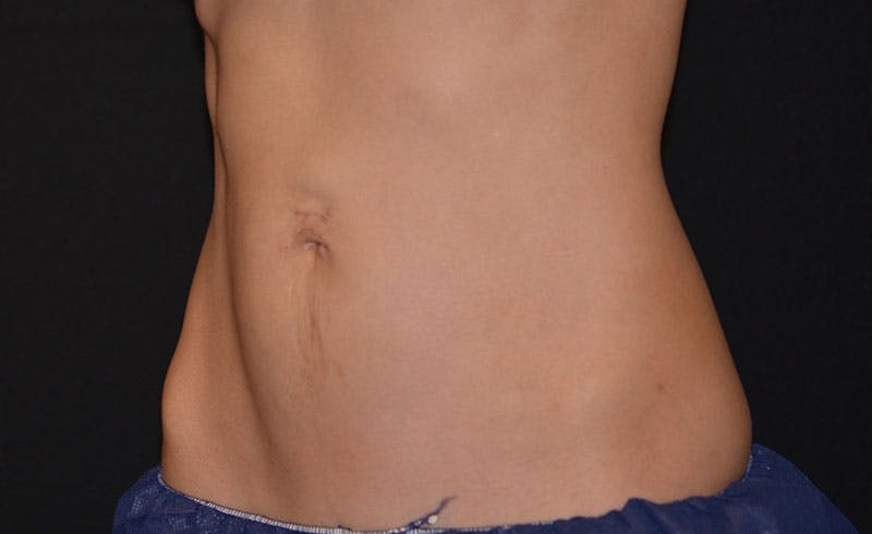 Female Love Handles Before & After Gallery - Patient 354260 - Image 2