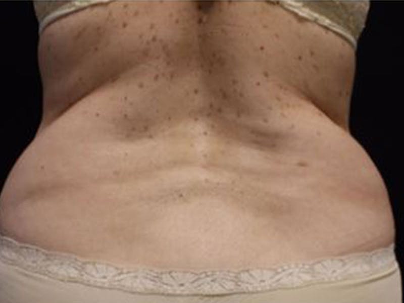 Female Love Handles Before & After Gallery - Patient 297455 - Image 1