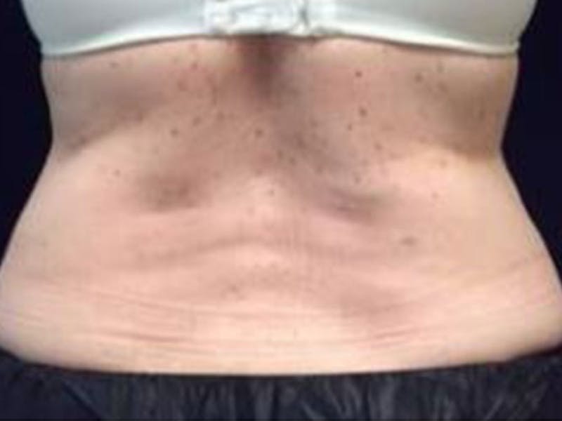 Female Love Handles Before & After Gallery - Patient 297455 - Image 2