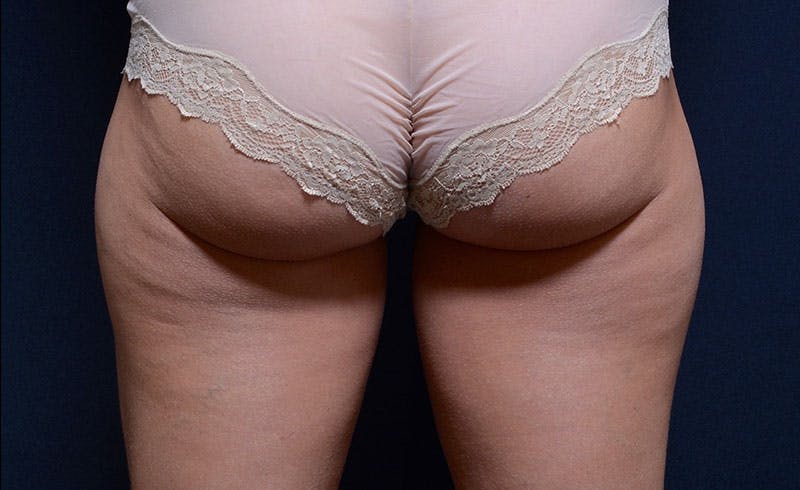 Female Outer Thighs Before & After Gallery - Patient 809673 - Image 1