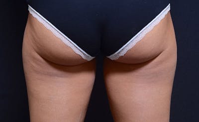 Female Outer Thighs Before & After Gallery - Patient 809673 - Image 2