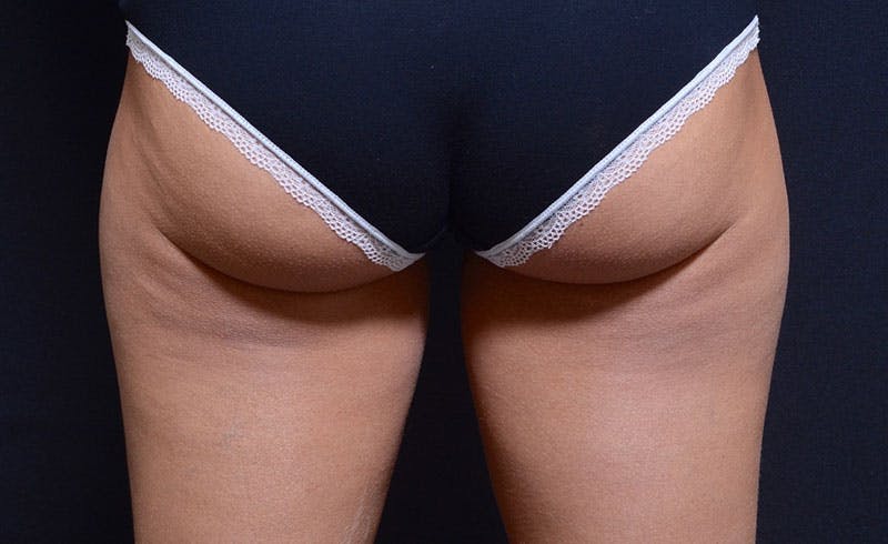 Female Outer Thighs Before & After Gallery - Patient 809673 - Image 2