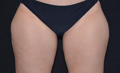 Female Outer Thighs Before & After Gallery - Patient 107879 - Image 1