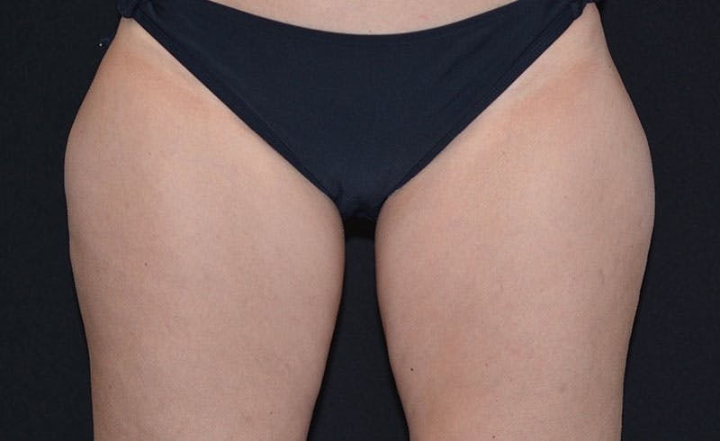 Female Outer Thighs Before & After Gallery - Patient 107879 - Image 1