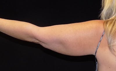Female Upper Arms Before & After Gallery - Patient 148109 - Image 1