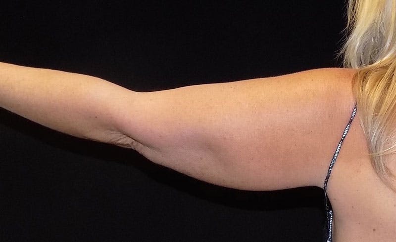 Female Upper Arms Before & After Gallery - Patient 148109 - Image 1