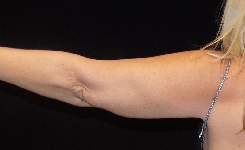 Female Upper Arms Before & After Gallery - Patient 148109 - Image 2