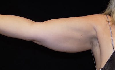 Female Upper Arms Before & After Gallery - Patient 374485 - Image 1