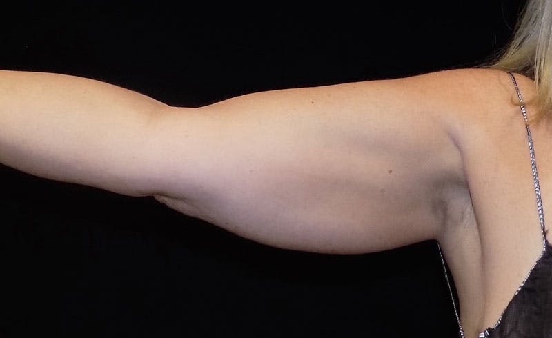 Female Upper Arms Before & After Gallery - Patient 374485 - Image 1