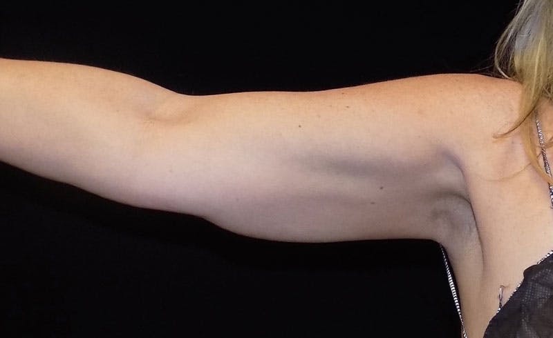 Female Upper Arms Before & After Gallery - Patient 374485 - Image 2
