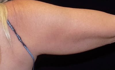 Female Upper Arms Before & After Gallery - Patient 265793 - Image 1