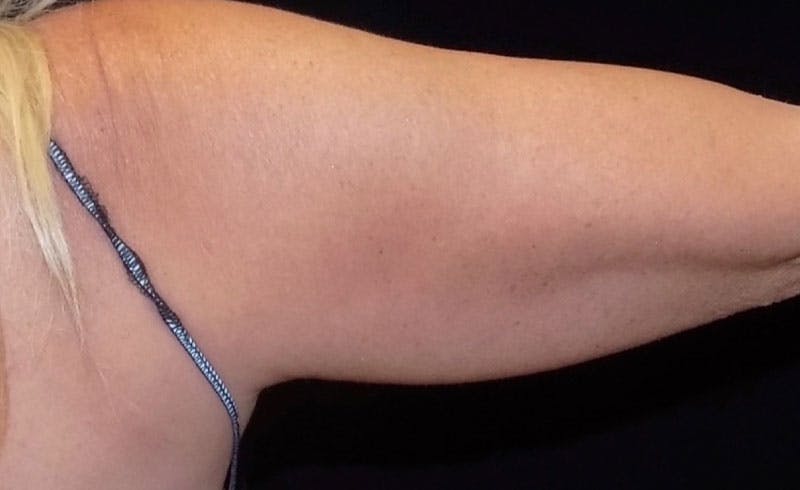Female Upper Arms Before & After Gallery - Patient 265793 - Image 1