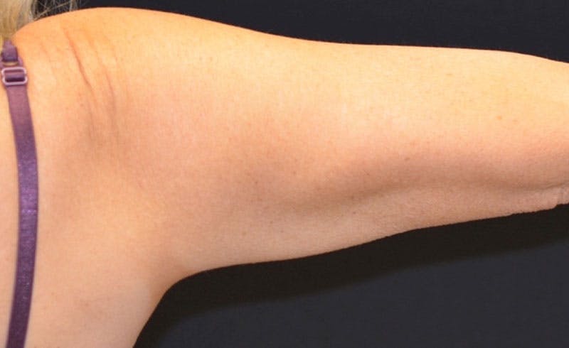 Female Upper Arms Before & After Gallery - Patient 265793 - Image 2