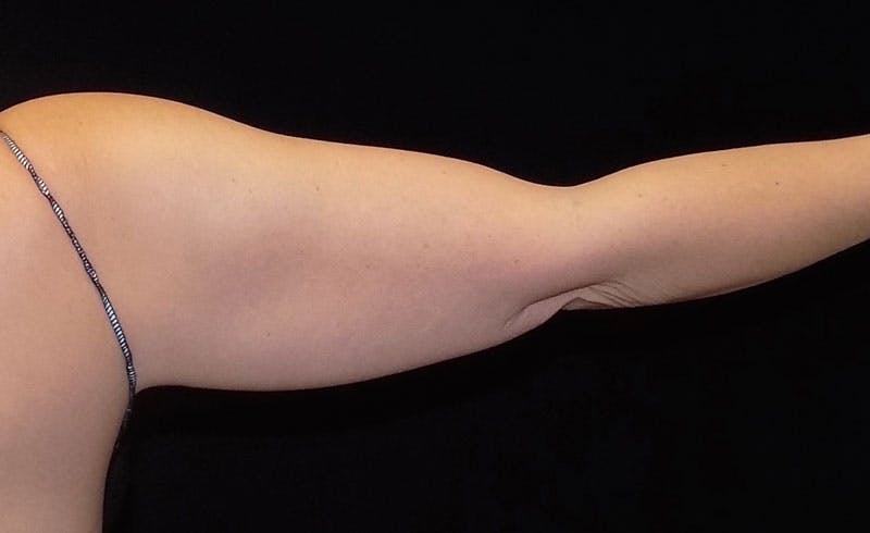 Female Upper Arms Before & After Gallery - Patient 858977 - Image 1