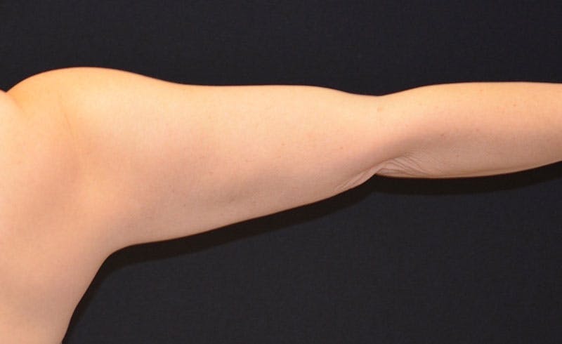 Female Upper Arms Before & After Gallery - Patient 858977 - Image 2