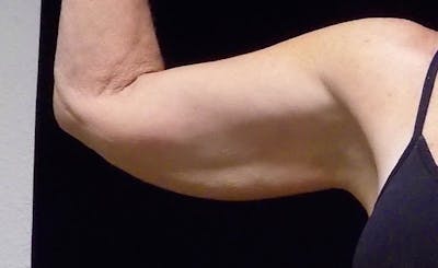 Female Upper Arms Before & After Gallery - Patient 394318 - Image 1