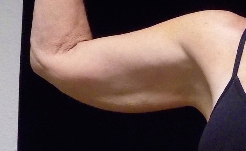 Female Upper Arms Before & After Gallery - Patient 394318 - Image 1