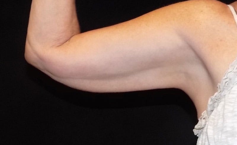 Female Upper Arms Before & After Gallery - Patient 394318 - Image 2
