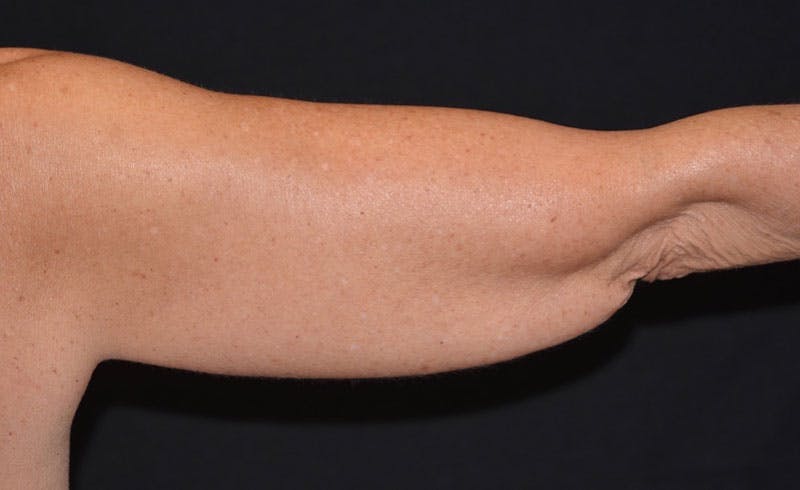 Female Upper Arms Before & After Gallery - Patient 949896 - Image 1