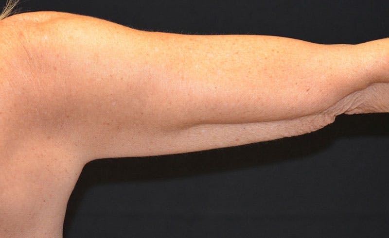 Female Upper Arms Before & After Gallery - Patient 949896 - Image 2