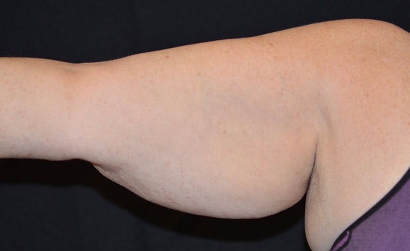 Female Upper Arms Before & After Gallery - Patient 255307 - Image 1