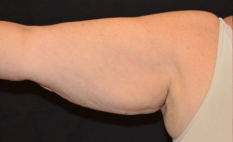 Female Upper Arms Before & After Gallery - Patient 255307 - Image 2