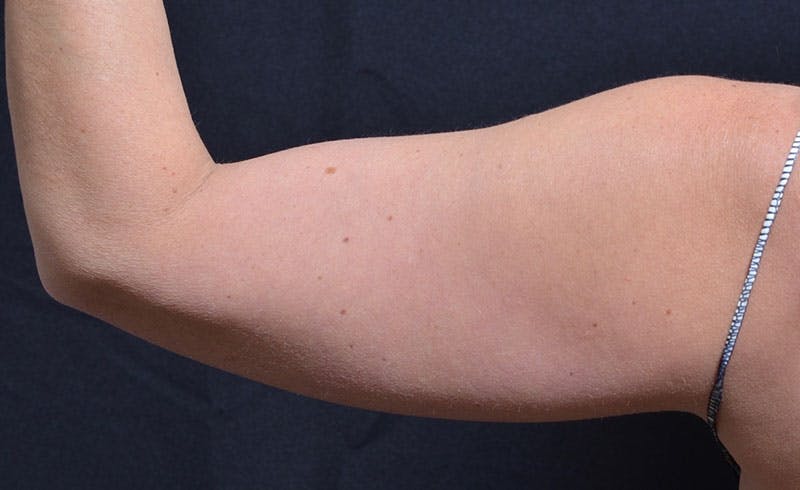 Female Upper Arms Before & After Gallery - Patient 297349 - Image 1