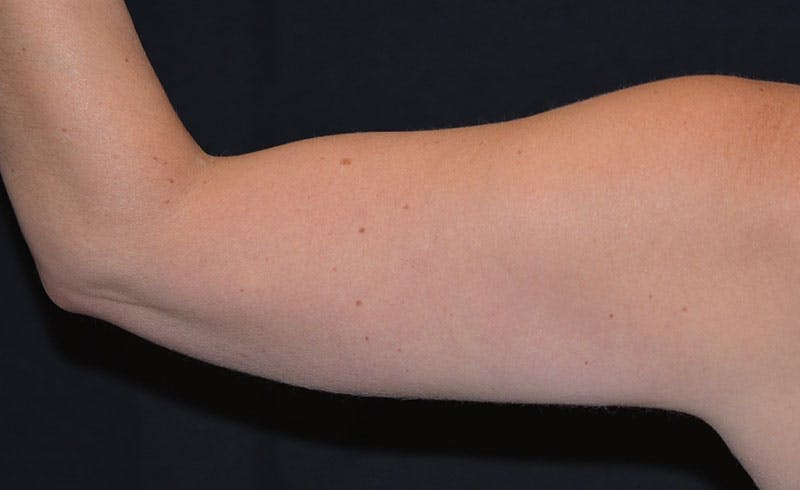 Female Upper Arms Before & After Gallery - Patient 297349 - Image 2