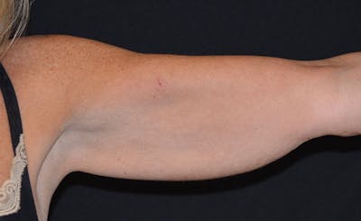 Female Upper Arms Before & After Gallery - Patient 276387 - Image 1