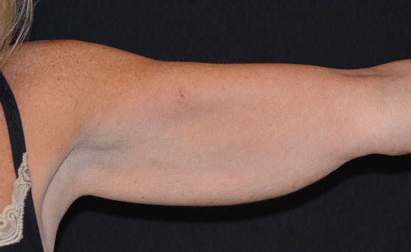 Female Upper Arms Before & After Gallery - Patient 276387 - Image 1
