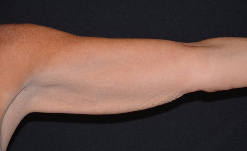 Female Upper Arms Before & After Gallery - Patient 276387 - Image 2
