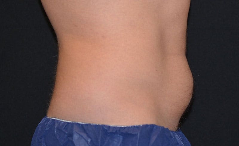 Male Abs Before & After Gallery - Patient 218820 - Image 1