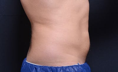 Male Abs Before & After Gallery - Patient 218820 - Image 2