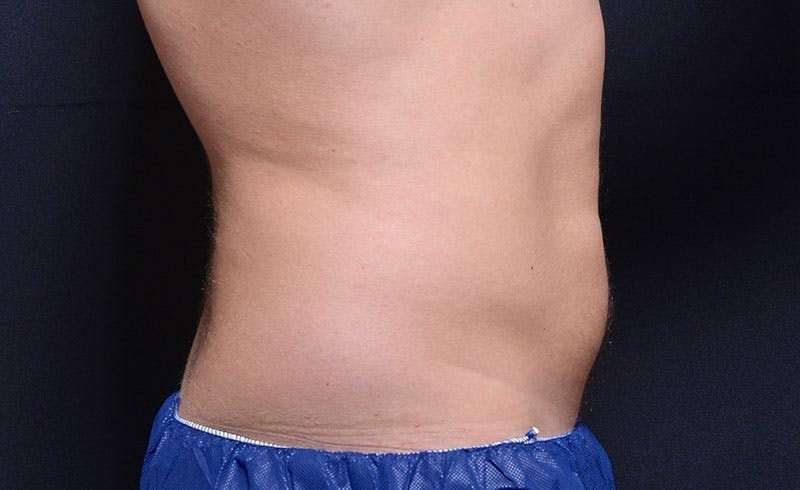 Male Abs Before & After Gallery - Patient 218820 - Image 2