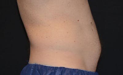Male Abs Before & After Gallery - Patient 648223 - Image 1