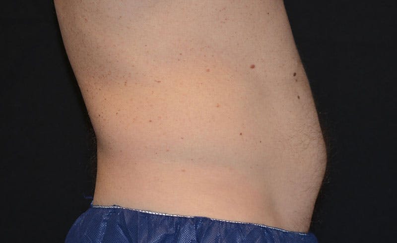 Male Abs Before & After Gallery - Patient 648223 - Image 1