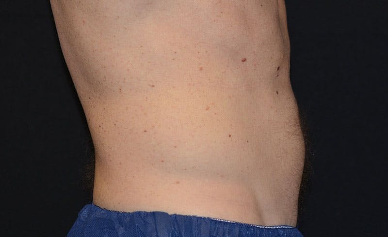 Male Abs Before & After Gallery - Patient 648223 - Image 2