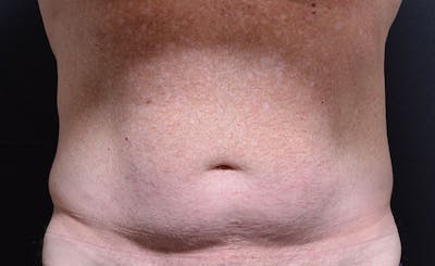 Male Abs Before & After Gallery - Patient 196687 - Image 1