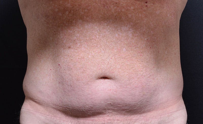 Male Abs Before & After Gallery - Patient 196687 - Image 1