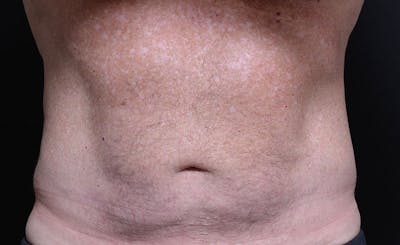 Male Abs Before & After Gallery - Patient 196687 - Image 2