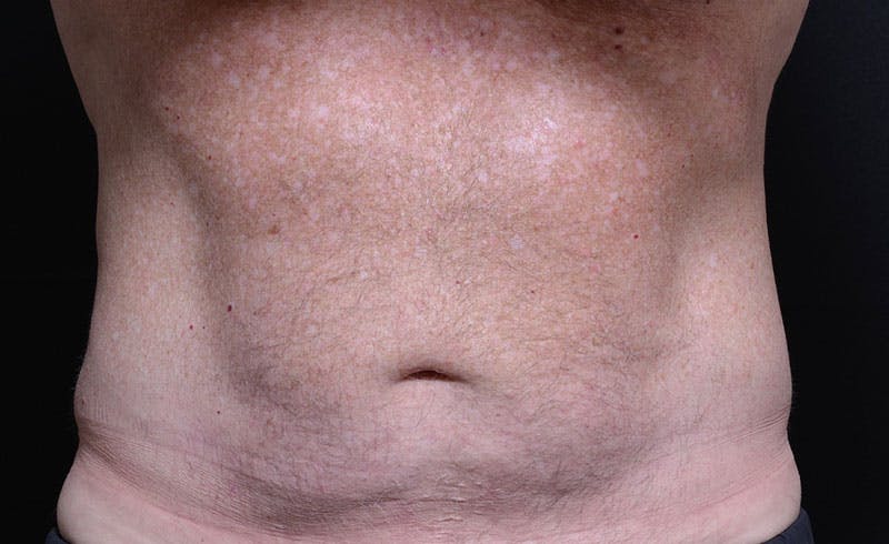 Male Abs Before & After Gallery - Patient 196687 - Image 2