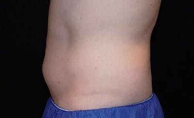 Male Abs Before & After Gallery - Patient 367781 - Image 1