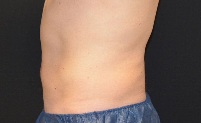 Male Abs Before & After Gallery - Patient 367781 - Image 2