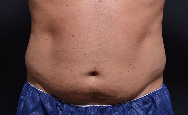 Male Abs Before & After Gallery - Patient 392150 - Image 1