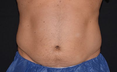 Male Abs Before & After Gallery - Patient 392150 - Image 2