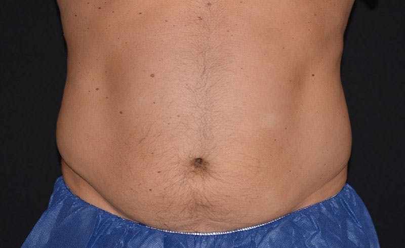 Male Abs Before & After Gallery - Patient 392150 - Image 2